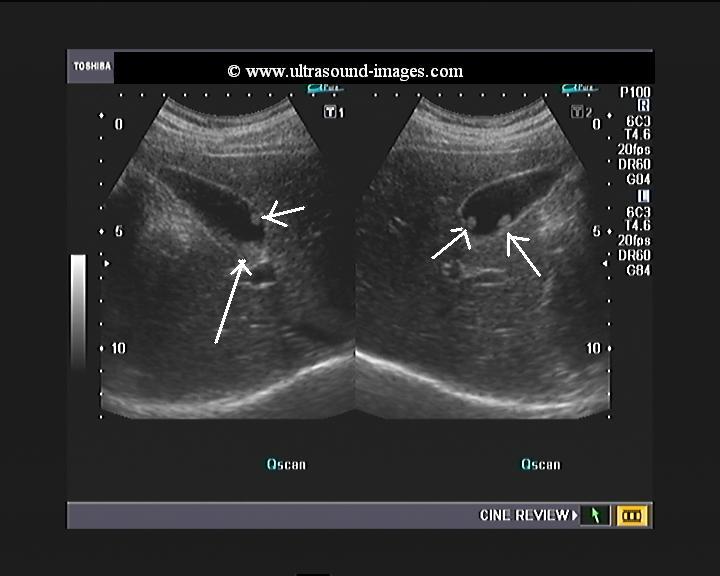 What happens during a gallbladder ultrasound?