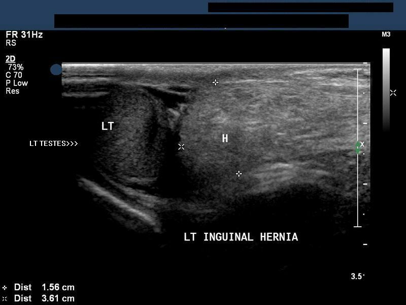 Ultrasound Pictures Of Inguinal Hernia 41