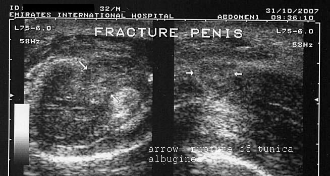 A Gallery Of High Resolution Ultrasound Color Doppler 3D Images Penis A Gallery Of High Resolution Ultrasound Color Doppler 3D Images Penis