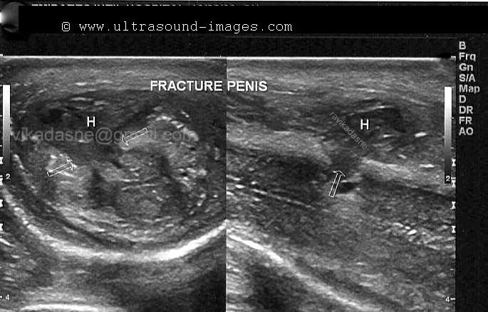 Penis Ultrasound 37
