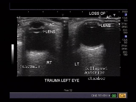 Eyes Ultrasound