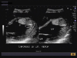 Heart CVS Ultrasound