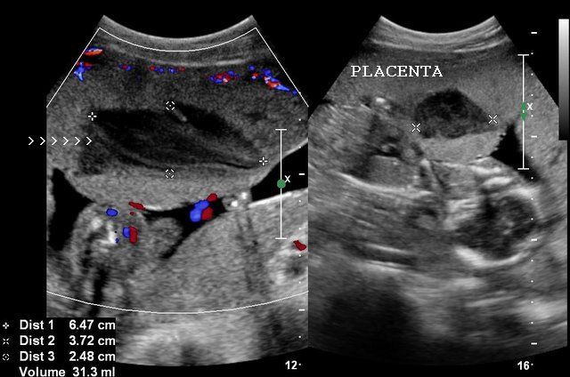 Ultrasound Images Of Placental Pathology Ultrasound Images Of Placental Pathology