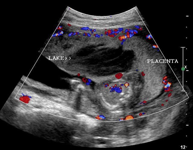 Ultrasound Images Of Placental Pathology Ultrasound Images Of Placental Pathology