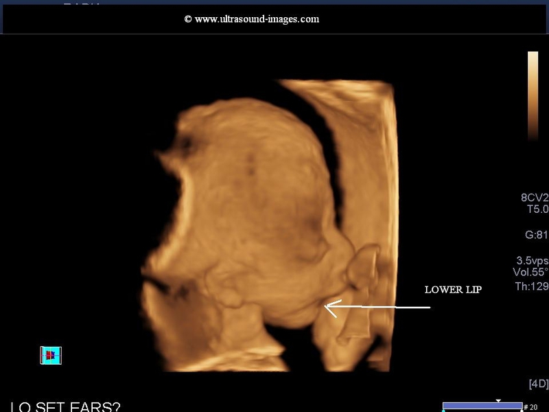A Gallery Of High Resolution Ultrasound Color Doppler 3d Images Fetal Face And Neck