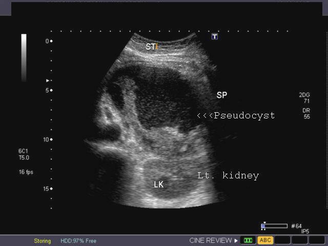 Pancreatic Pseudocyst Ultrasound Pancreatic Pseudocyst Ultrasound