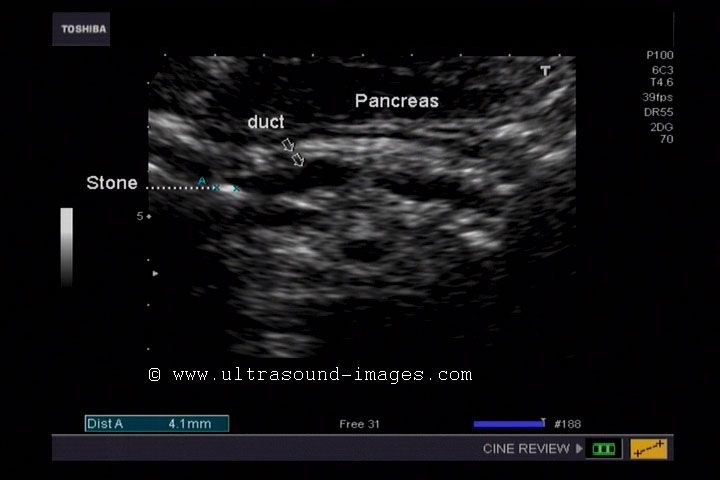 pancreas ultrasound
