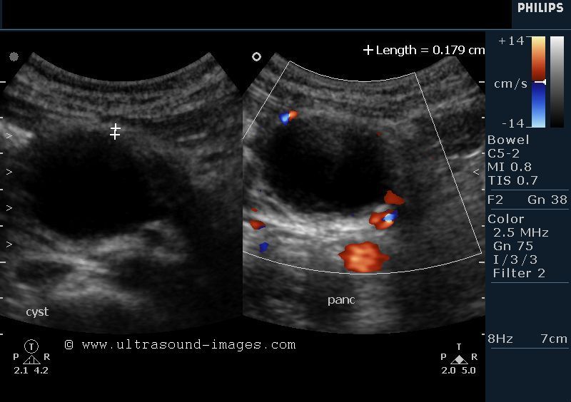 Pancreatic Pseudocyst Ultrasound Pancreatic Pseudocyst Ultrasound