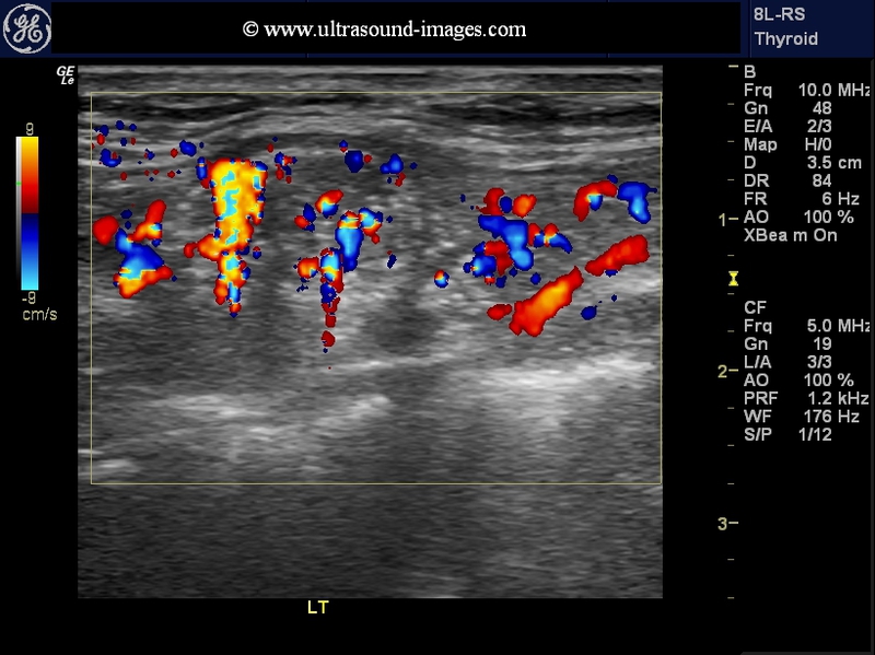 A Gallery of High-Resolution, Ultrasound, Color Doppler & 3D Images -  Thyroid-2