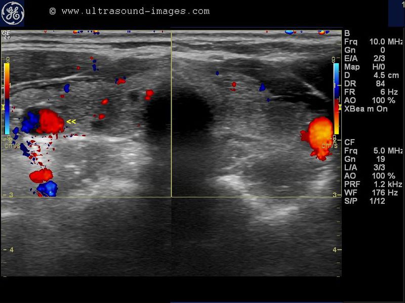 A Gallery of HighResolution, Ultrasound, Color Doppler