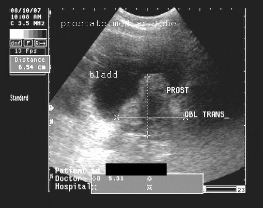 Benign Prostatic Hypertrophy Ultrasound