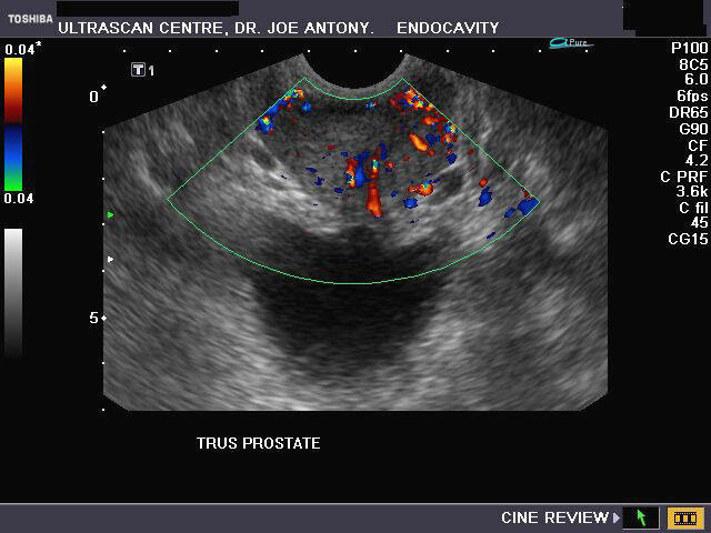 prostatitis ultrasound images Fájdalom kezelése a prosztatarákhoz