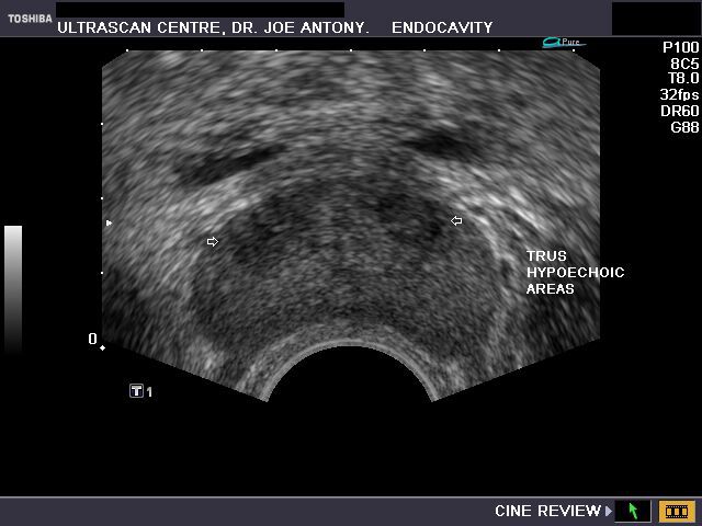 hyperechoic nodule prostate ultrasound)