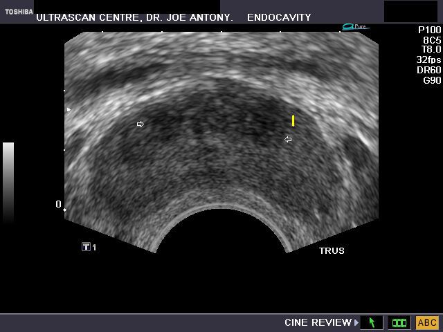prostatitis ultrasound