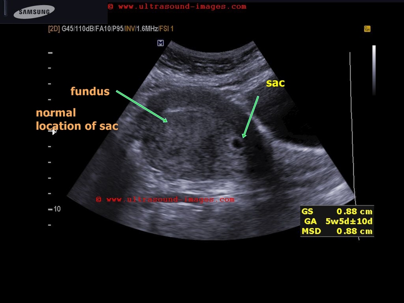 Ultrasound Images Of Early Pregnancy Ultrasound Images Of Early Pregnancy