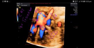 STIC 3D/ 4D ultrasound image truncus arteriosus