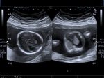 fetal-hydrothorax-2a