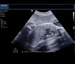 image  shows the fetal aortic arch