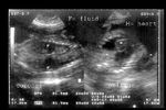 fetal-pleural-effusion-1c
