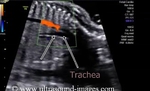 CHAOS-trachea-1c