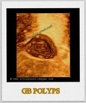 GB-polyps-3D