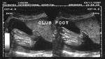 Fetal club foot 
