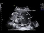 Sacrococcygeal teratoma fetal