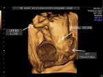 Sacrococcygeal teratoma fetal