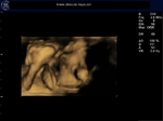 Fetus sucking thumb- 3D