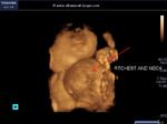 multiple cystic hygromas in neck and chest - 3D