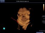 multiple cystic hygromas in neck and chest - 3D