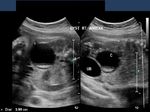 ovarian-dermoid-fetal