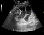 dilated-fetal-bowel