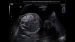 echogenic-fetal-bowel
