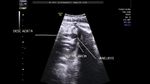 fetal-aortic-aneurysm