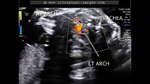 double-aortic-arch