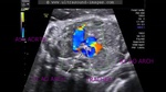 double-aortic-arch