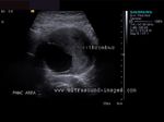 anuerysm-aorta