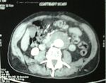 aortic-aneurysm-CT-plain