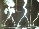 aortic-aneurysm-CT-3D