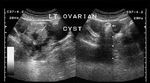 ovarian-dermoid