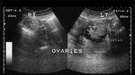 ovarian-dermoid