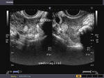 ovarian-cyst-ruptured