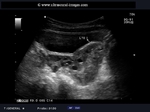 torsion-left-ovary