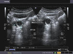 calcified-ovary