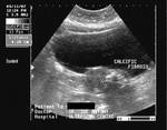 calcific-fibroid