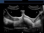 didelphys-uterus