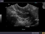hypoplastic-uterus