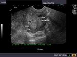 adenomyosis-uterus