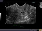 polyp-cervix-pedunculated